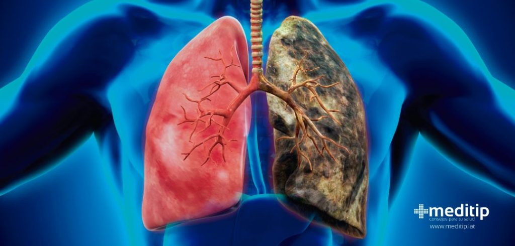 Cáncer De Pulmón