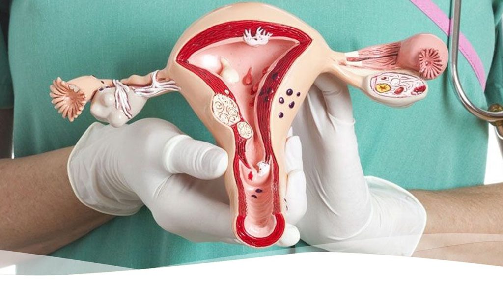 ¿Cuándo Se Pueden Presentar Los Síntomas Del Síndrome De Ovarios Poliquísticos?