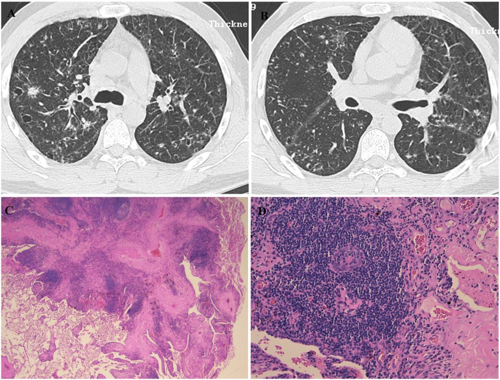 Iagnostico Broncolitis