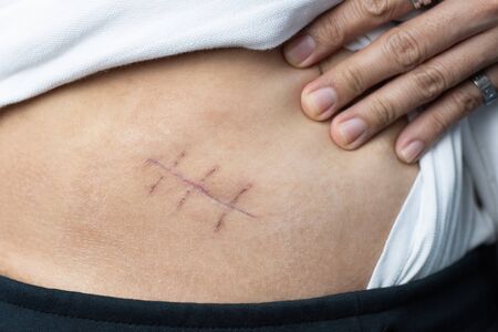 apendicitis