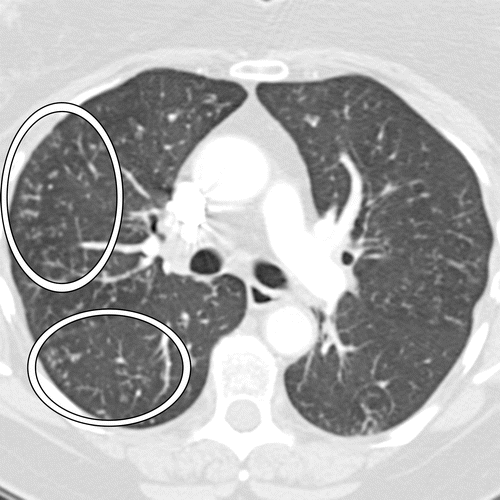 Tac Bronquiolitis