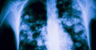 ¿Cuál Es La Diferencia Entre Neumonía Y Bronquitis?