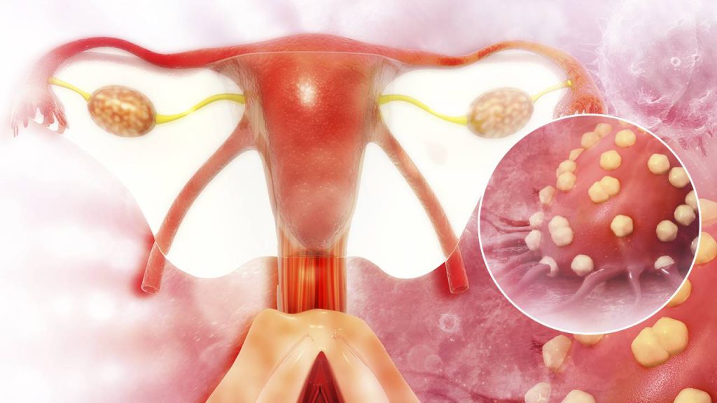 Tipos De Cáncer De Ovarios