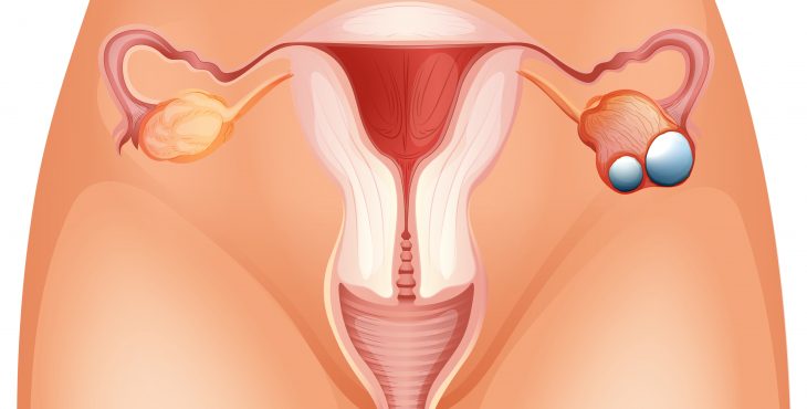 Cáncer De Ovarios