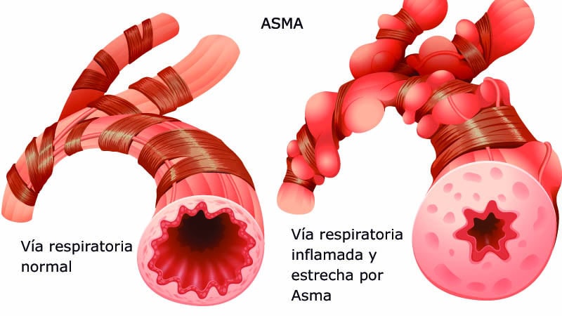 Crisis de asma, lo que debes saber 