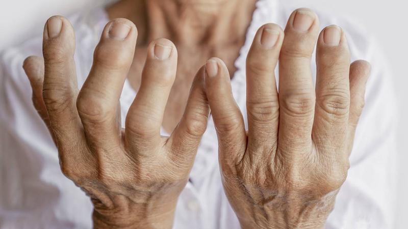 Artritis Reumatoides: inflamación de las articulaciones 