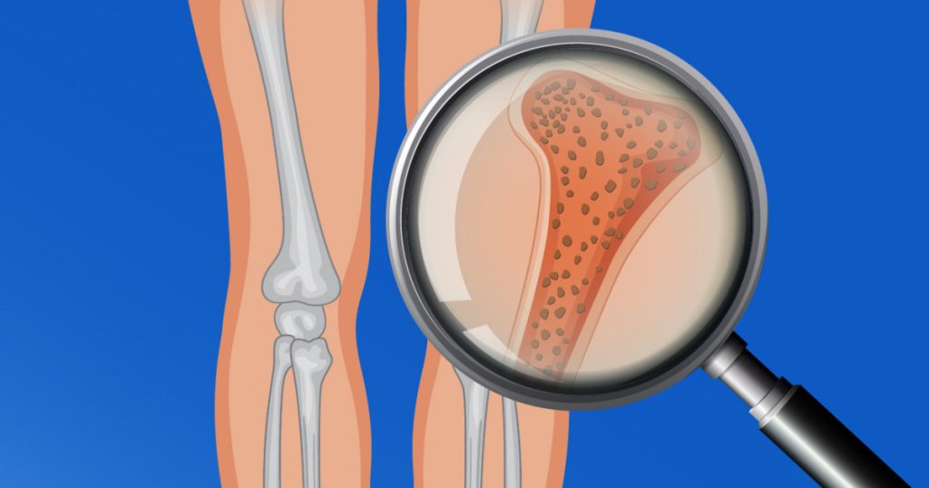 Puedes tener debilidad en tus huesos: Osteoporosis 