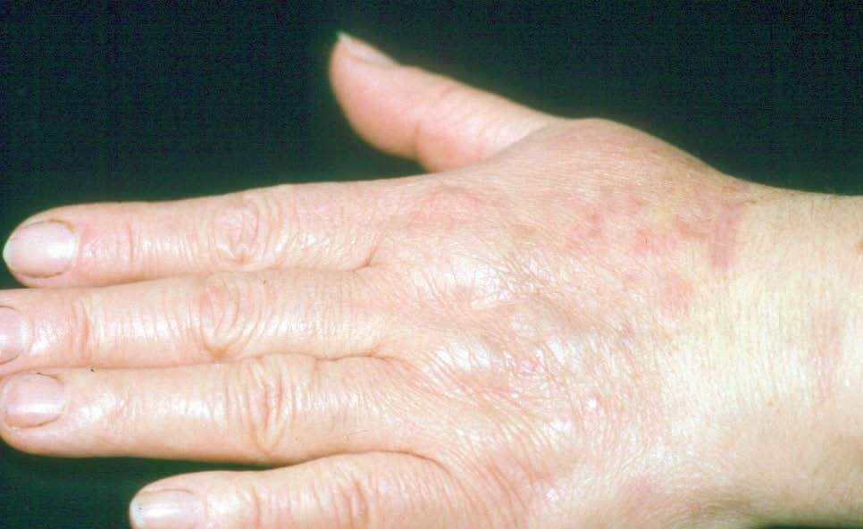 Acantosis Nigricans