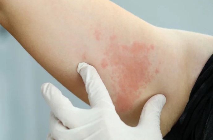 Otras Infecciones Bacterianas Comunes Son