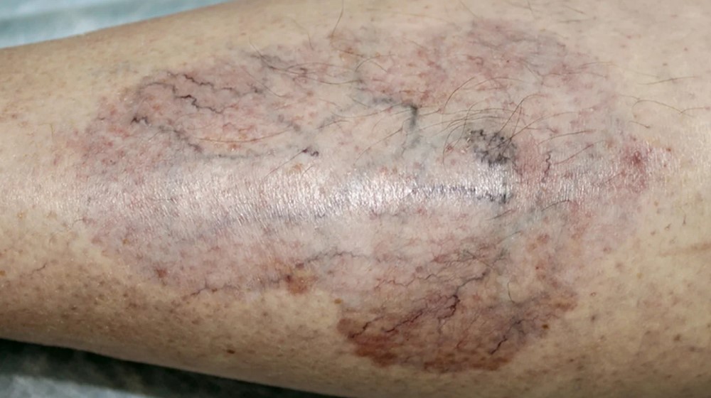 Necrobiosis Lipoidica Diabeticorum