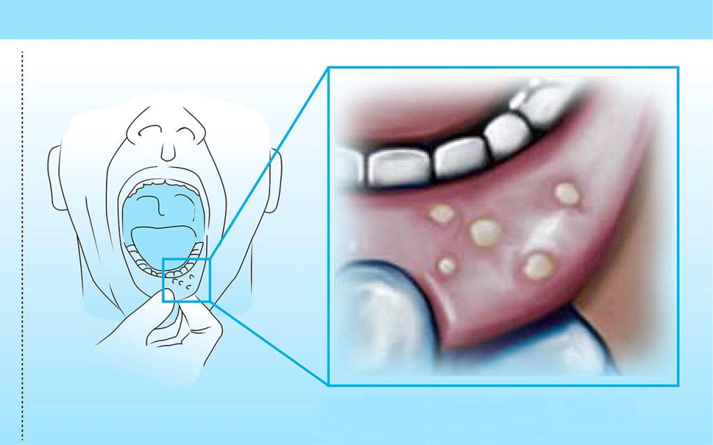 vejigas o llagas bucales