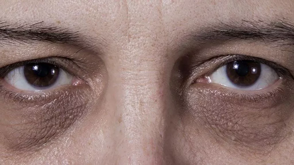 Ojeras