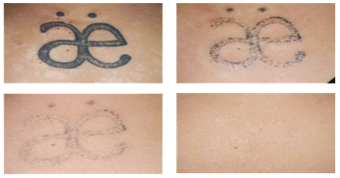 Formas Creativas De Tapar Los Tatuajes De Un Ex