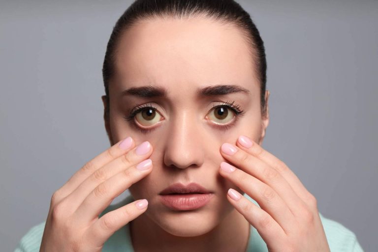 ¿Cuáles son las causas de los ojos amarillos y dónde tratarlos?, el Instituto Oftalmológico Dexeus lo explica
