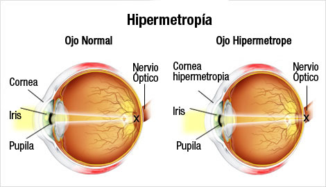 ¿Cómo afecta la hipermetropía a los seres humanos?