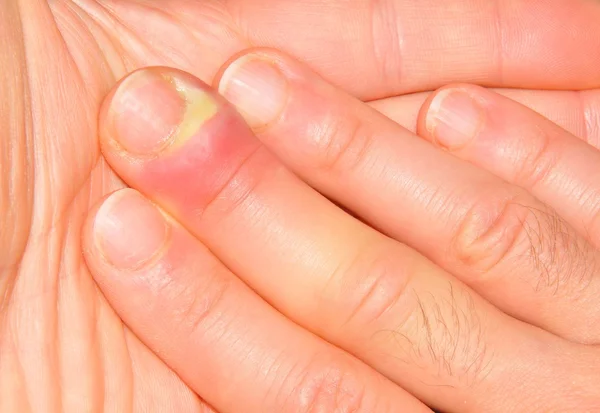 Puedes contraer infecciones en las uñas 