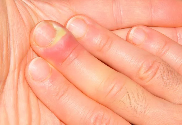 Puedes Contraer Infecciones En Las Uñas 