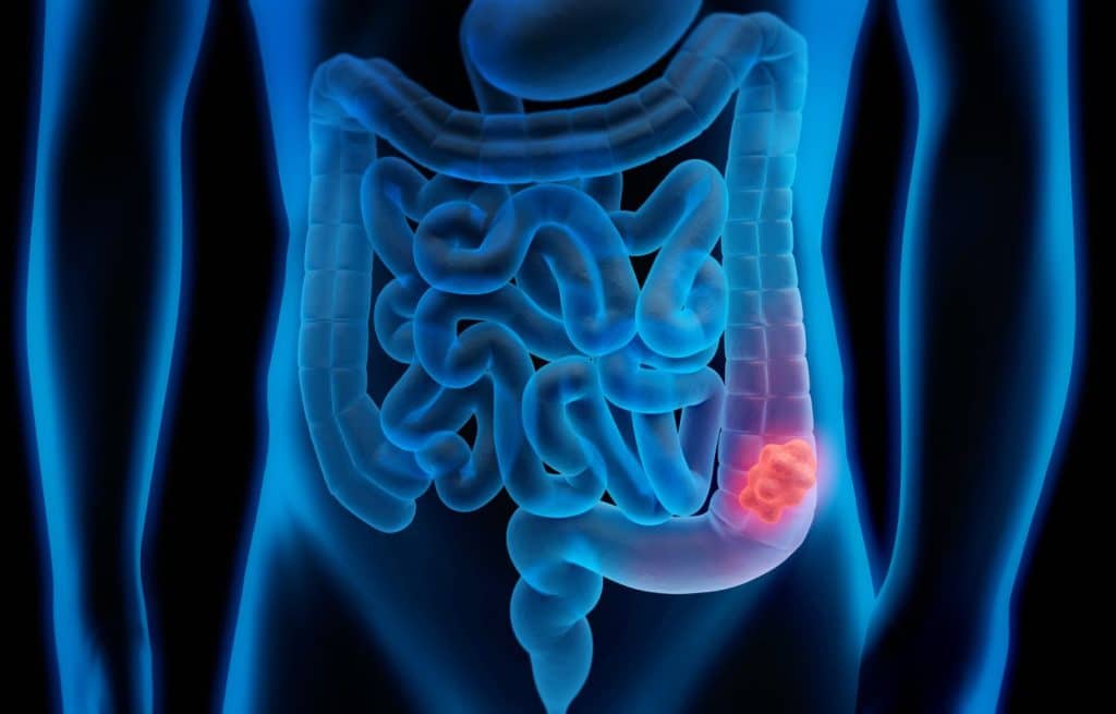 Síntomas de la disbiosis intestinal