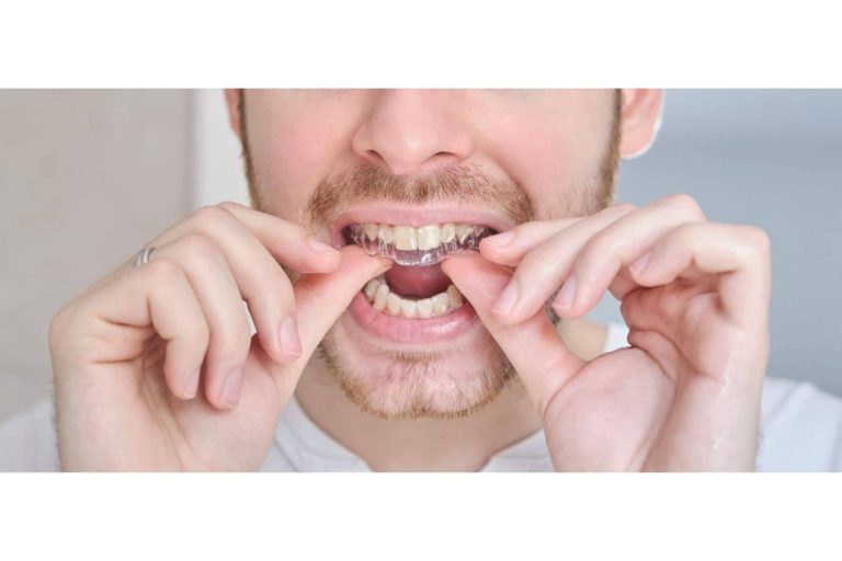 ¿Cuáles son las ventajas de la ortodoncia invisible?, por Clínica Dental Delgado