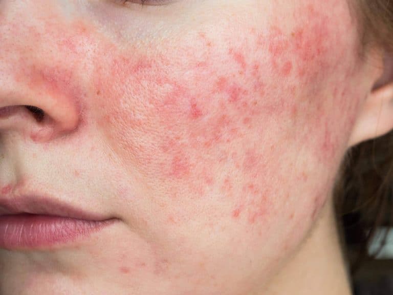 ¿Cómo hay que cuidar correctamente la rosácea? Los expertos de La Para-Farmacia del Puerto