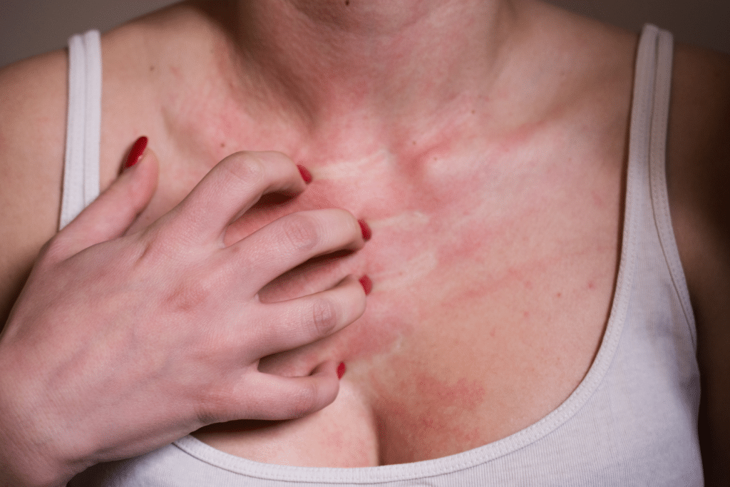 Cómo Saber Si Tus Síntomas Primaverales Son De Alergia