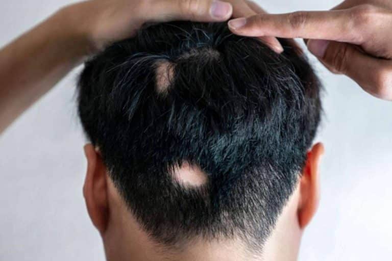 En qué consiste la alopecia areata y cómo disminuirla