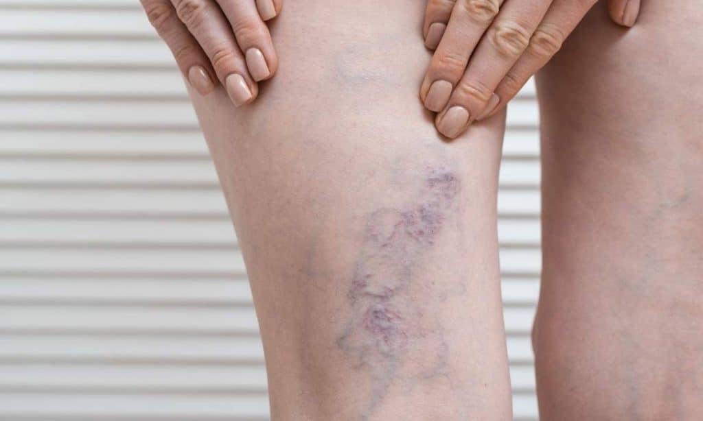 Mejor Tratamiento Para Varices