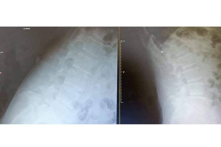 Retirada de hernia discal con el procedimiento que ofrece el Instituto Francés de Columna Biziondo