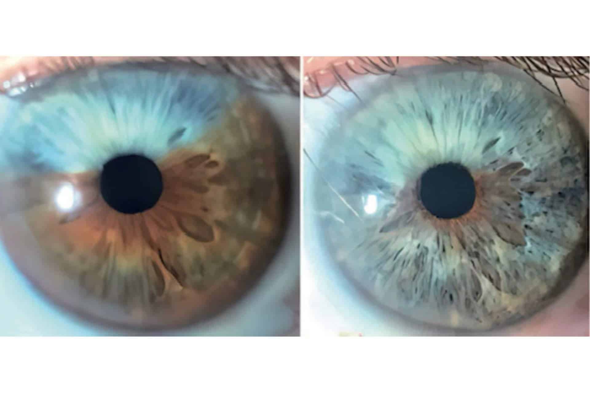 Clínica Eyecos afirma que los heterocromías y los nevus del iris pueden