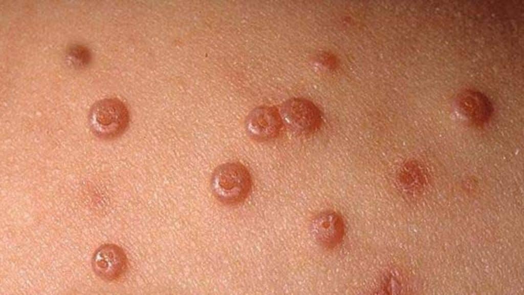 ¿Cómo Tratar Las Verrugas?