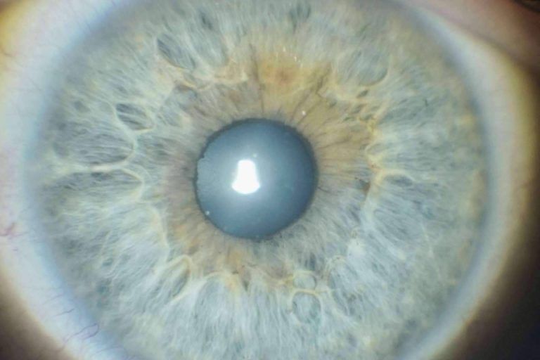 La revolucionaria iridoplastia láser en la Clínica Eyecos. Cambio de color de ojos seguro, efectivo y natural