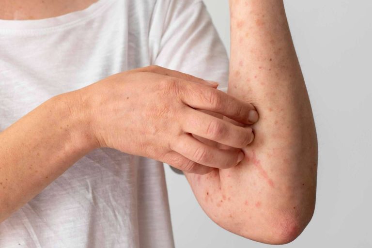Los luchadores contra el eczema ahora cuentan con un superhéroe, Novopiel