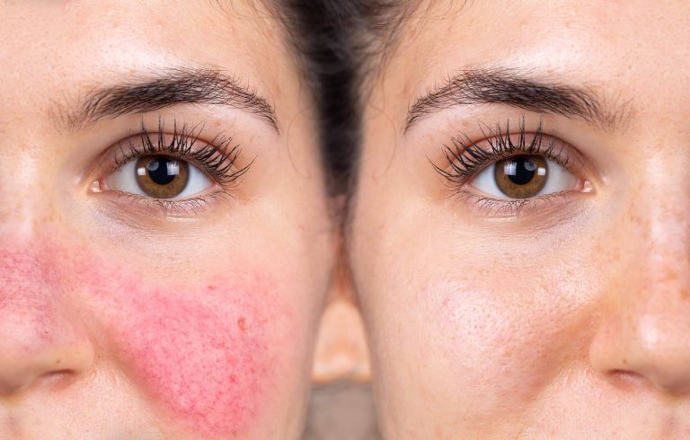 ¿Cómo eliminar las manchas en la piel? Con el láser Q Switched Nd Yag del Centro Médico El Pilar