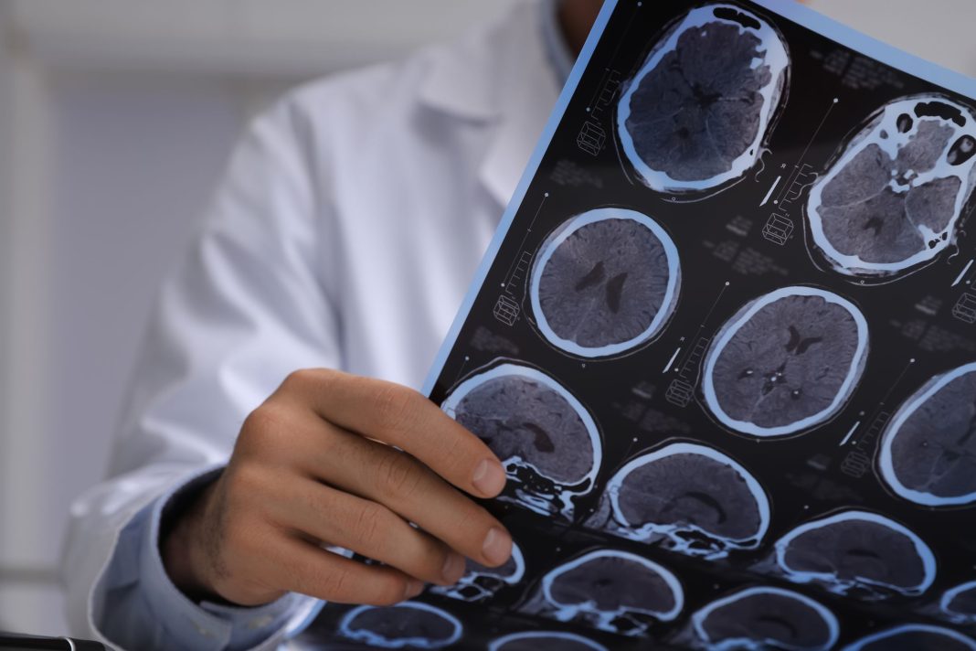 Alzheimer: cuando el estilo de vida es parte del tratamiento