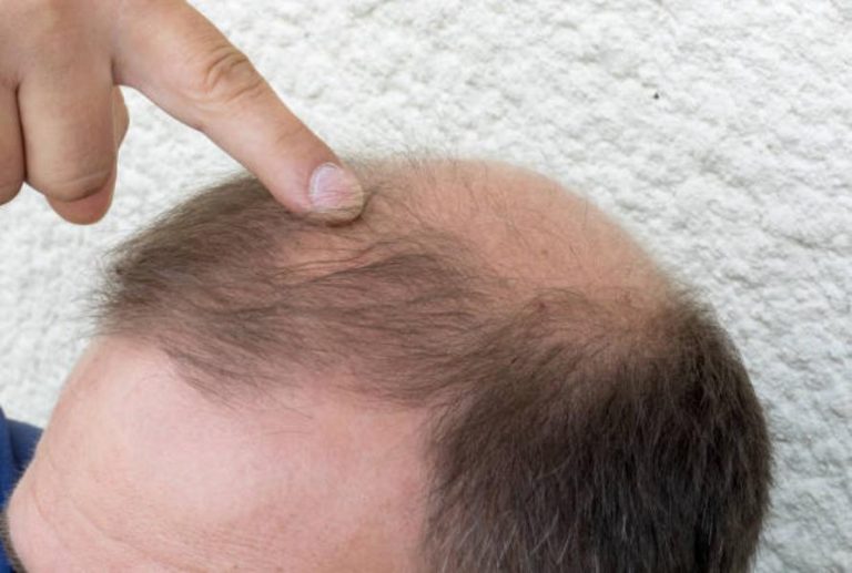Todo lo que Necesitas Saber sobre el Trasplante Capilar en Svenson: Soluciones Efectivas y Naturales para la Pérdida de Cabello