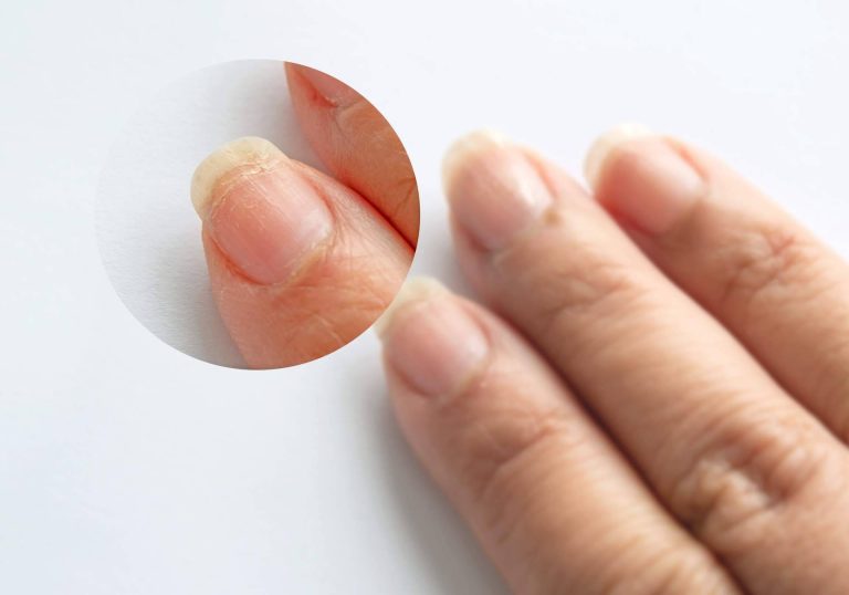 Lazonail® es un tratamiento holístico para uñas y cutículas