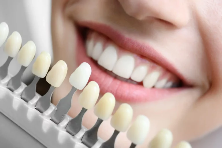 Blanqueamiento dental: ventajas y resultados