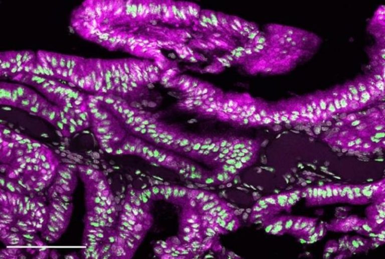 La terapia para reducir el colesterol puede prevenir un tipo agresivo de tumor colorrectal, según un estudio