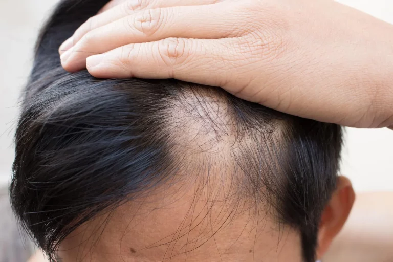 alopecia