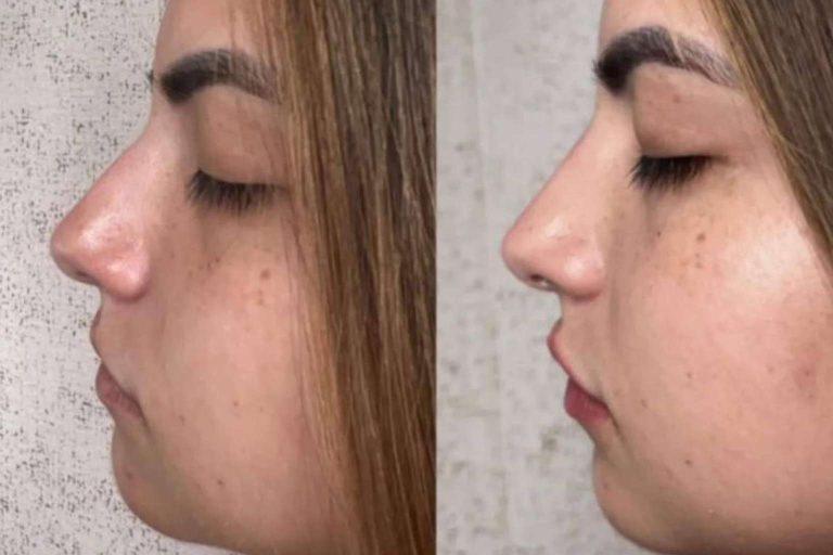 La clínica del Dr. Guidi tiene especialistas en rinomodelación en Málaga