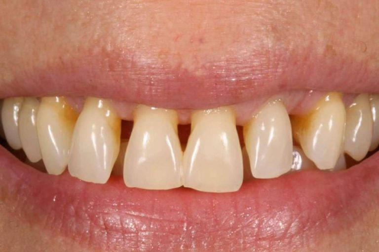 La Clínica Dental Ruiz de Gopegui explica cómo tratar la gingivitis
