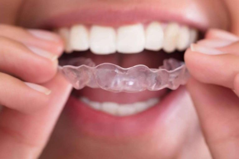 Las ventajas de la Ortodoncia Invisible Fast, por los especialistas de Lola Escalante Estudio Dental