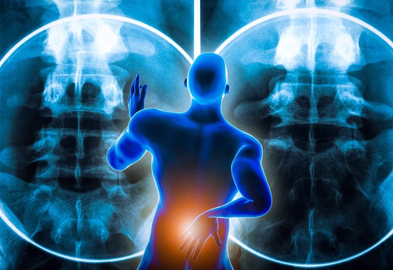 ¿Qué es la hernia discal y la técnica de andulación?, de la mano de iXalud