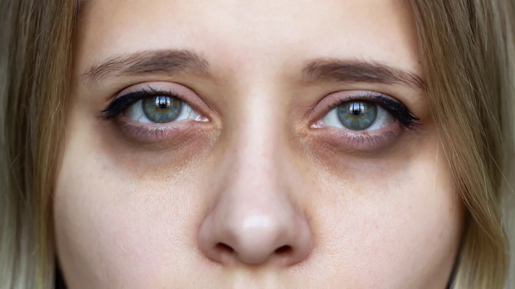 Remedios Caseros Para Combatir Las Ojeras