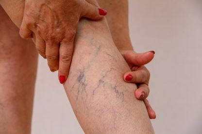 El dolor y pesadez habitual de piernas podrían ser «signos de reflujo venoso»