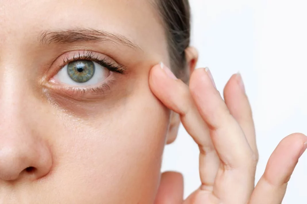 Consejos para el tratamiento de las ojeras