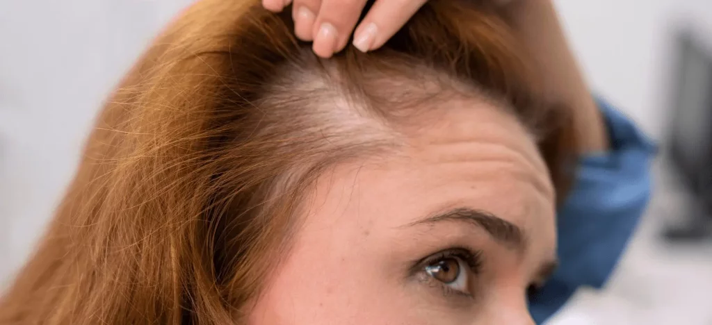 Productos Naturales Para Prevenir La Caída Del Cabello