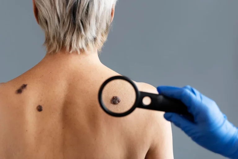Cómo borrar las verrugas de tu cuerpo de forma 100% natural y efectiva