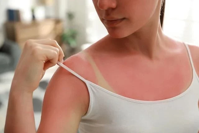 ¡Basta de cremas! Los 5 remedios caseros para las quemaduras de sol en el verano
