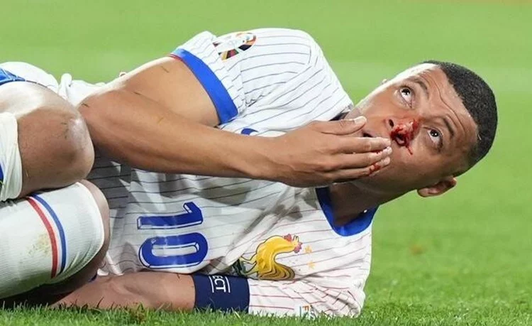 Mbappe Fractura Dr Ripoll Real Madrid